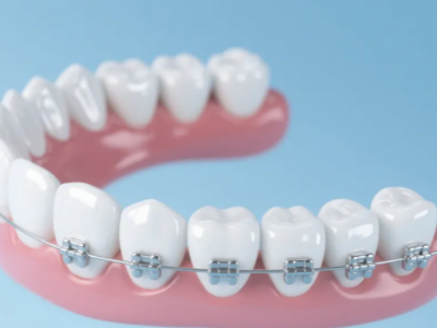 想做牙齒矯正，哪種方案更適合你？