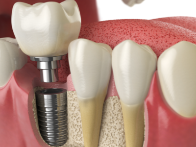 選擇種植牙后要做哪些日常維護(hù)？