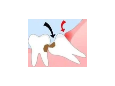 吃完飯后老塞牙？別大意！這可能是你的牙齒在報警