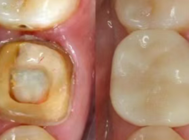 根管治療（抽神經(jīng)）后，為什么一定要做牙冠？