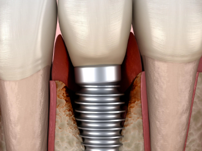 種植牙的術(shù)前準(zhǔn)備有哪些？