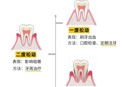 老年人牙齒松動了要怎么辦？