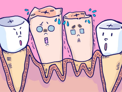 人工種植牙系列——即刻種植術講解