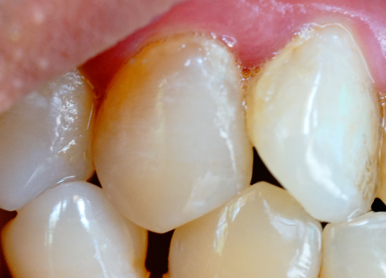 牙齒表面的牙釉質掉了還可以修復嗎？