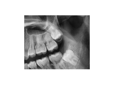 既然「智齒」不宜久留，為什么不能一次性拔掉？