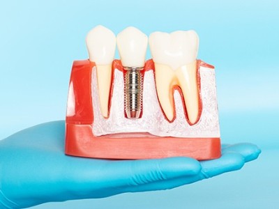 種牙VS鑲牙，你適合哪種?