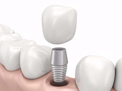 在承德哪家口腔醫(yī)院口腔種植齒好一點，惟德口腔醫(yī)院值得您的選擇