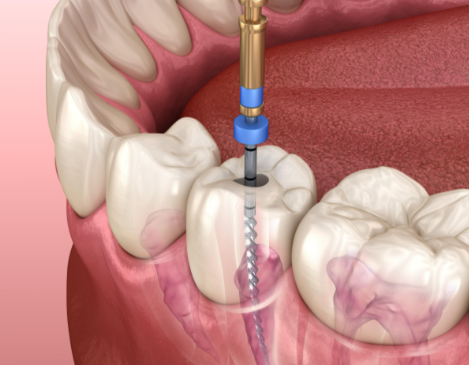 根管治療后的注意事項有哪些？