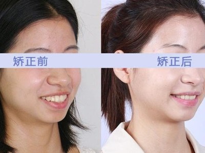 牙齒矯正與正畸的區(qū)別及治療護(hù)理要點(diǎn)